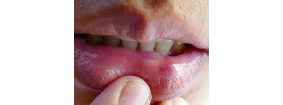 Afta na boca: o que causa, tipos e como aliviar a dor - Minha Vida