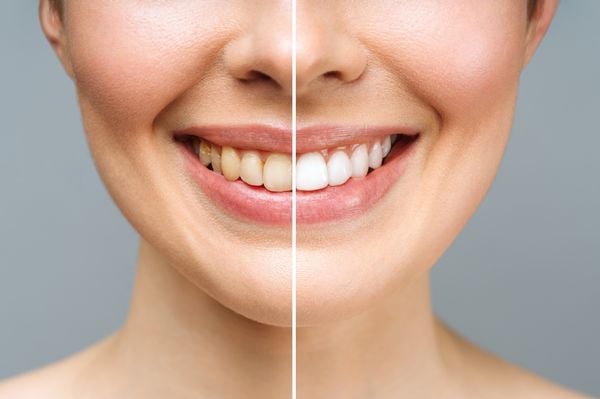 Antes e depois de um sorriso que era amarelado