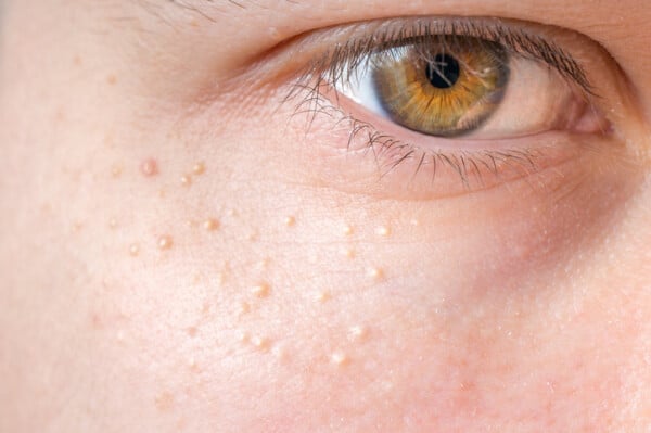 Milium na área do rosto. Foto: vchal | Getty Images