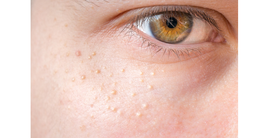 Milium na área do rosto. Foto: vchal | Getty Images