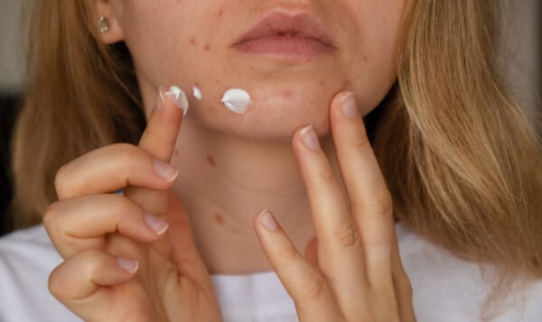 metade do rosto de uma mulher com acne. ela está aplicando pomada para acne