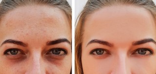Antes e depois do tratamento para olheiras. Foto: TanyaLovus | Getty Images