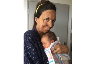 Mulher que teve 65% do corpo queimado deu à luz seu primeiro filho - foto: Divulgação/Instagram 
