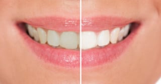 Clareamento dental: cuidados do paciente antes e depois do tratamento