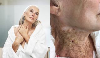 À esquerda, mulher idosa passa hidratante na região do pescoço; à direita, imagem do pescoço com manchas de uma senhora de 92 anos.