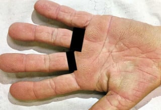 Brasileira tem rara condição de mãos aveludadas ligada ao câncer - Foto: Reprodução/The New England Journal of Medicine