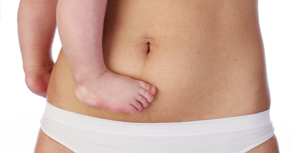 Diástase abdominal após o parto: Fisioterapeuta ensina a descobrir se você tem