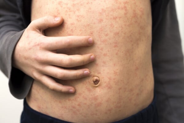 Foto aproximada de barriga de criança com manchas vermelhas, sintoma principal do sarampo