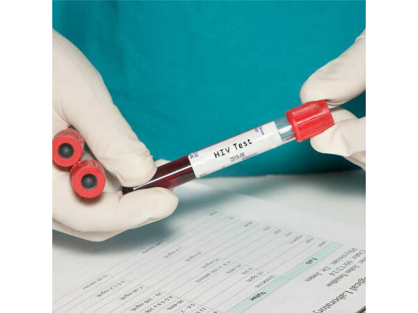 HIV: tire suas dúvidas sobre os testes de diagnóstico