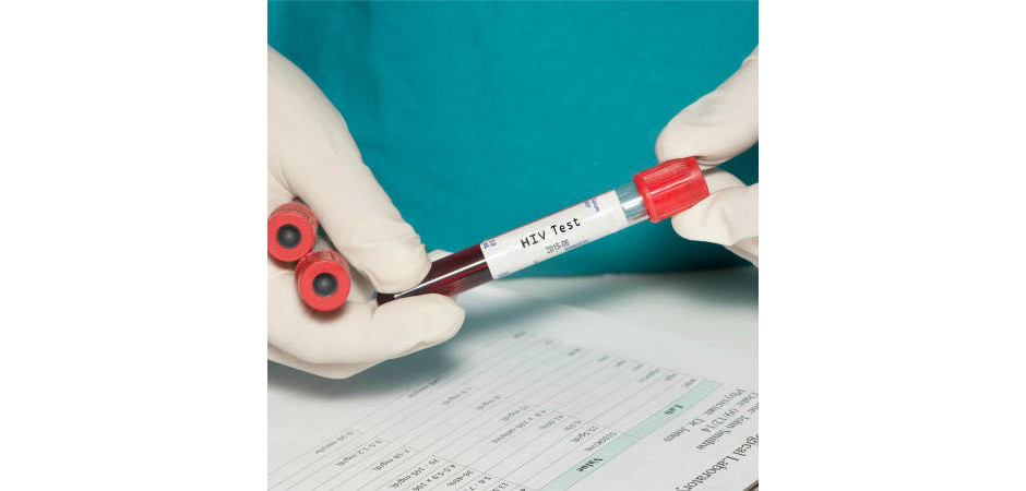 HIV: tire suas dúvidas sobre os testes de diagnóstico