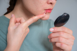 Mulher aplicando pomada em herpes na boca segurando um espelho de mão