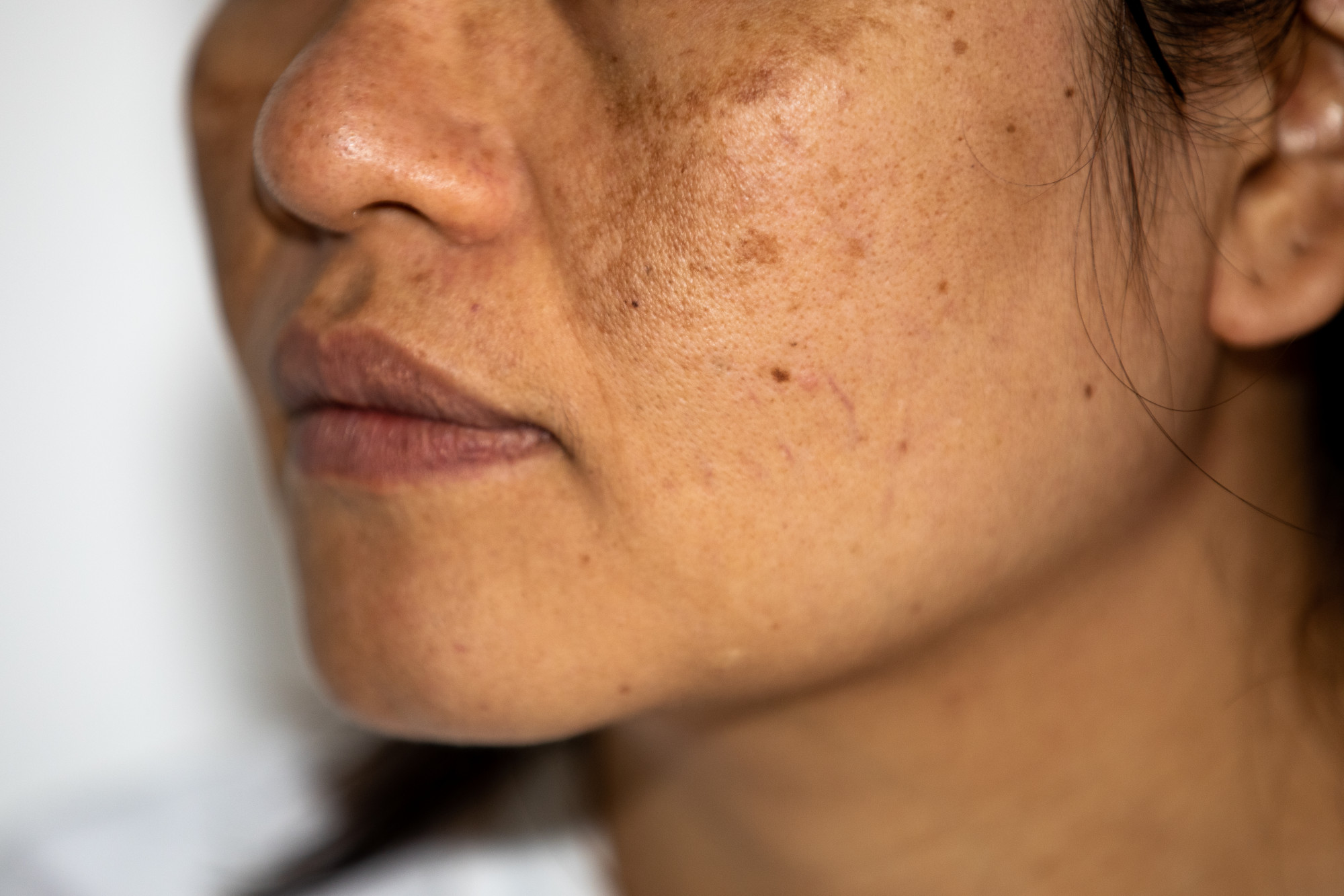 Tratamento Para Melasma Veja 7 Op es Minha Vida