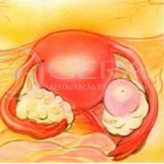 Ilustração de um ovário micro-policístico e folículo noutro ovário - foto: Joji Ueno