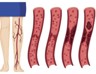 Trombose pode matar? Conheça as complicações