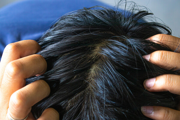 Imagem do couro cabeludo oleoso