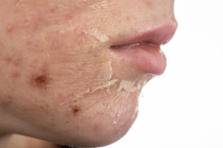 Descamação na pele renova as células