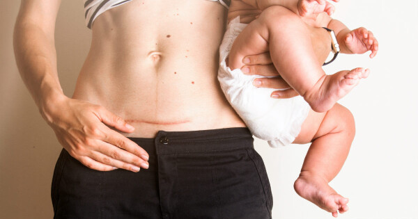 Mulher com cicatriz de cesárea segurando seu bebê