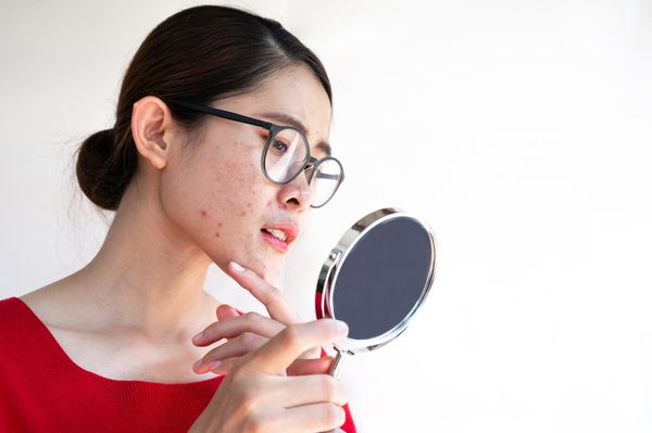 mulher com pele com acne se olhando no espelho