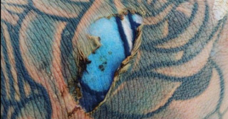 tatuagem "renovada" após queimadura 