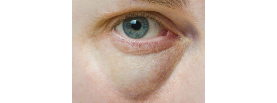 Blefaroplastia inferior elimina bolsas de gordura abaixo dos olhos