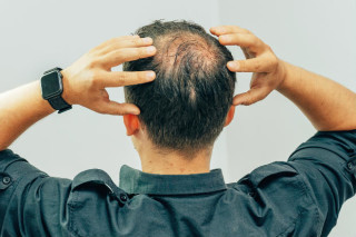 Alopecia androgenética atinge 50% da população masculina - Foto: Yashkin Ilya/Shutterstock
