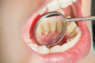 Tártaro nos dentes: 4 complicações que o quadro pode causar