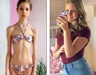 Menina achou no amor a cura para anorexia