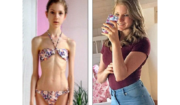 Menina achou no amor a cura para anorexia