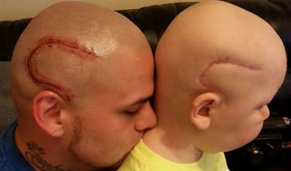 Gabriel e o pai Josh com suas "cicatrizes" iguais - Foto: Reprodução Facebook