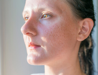 Mulher com cicatrizes de acne no rosto
