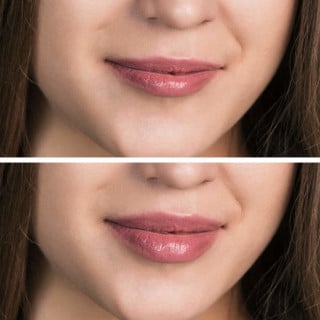 Antes e depois do preenchimento labial. Foto:Shutterstock/Kotin