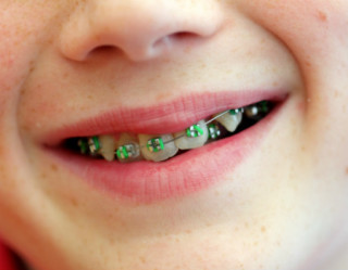 Adolescente com aparelho nos dentes