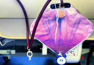 Mulher tem urina roxa após 10 dias de internação na França - Foto: Reprodução/The New England Journal of Medicine