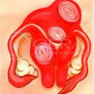 Miomas uterinos - imagem: Joji Ueno