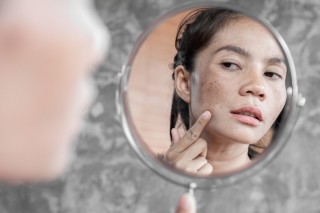 O que realmente funciona para o tratamento de manchas na pele?