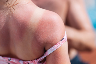 Conheça doenças de pele comuns causadas por exposição ao sol