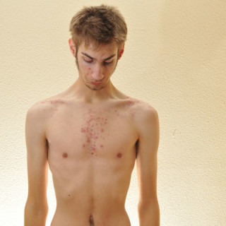 Anorexia - Foto: Getty Images