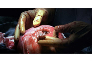 O bebê ficou conhecido como ?mãos da esperança" - foto: Divulgação/michaelclancy