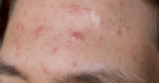 Graus de acne: entenda os diferentes tipos de tratamento