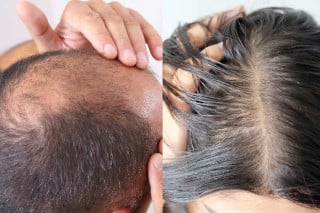Alopecia androgenética (calvície) - Foto: Por BOKEH STOCK/Shutterstock