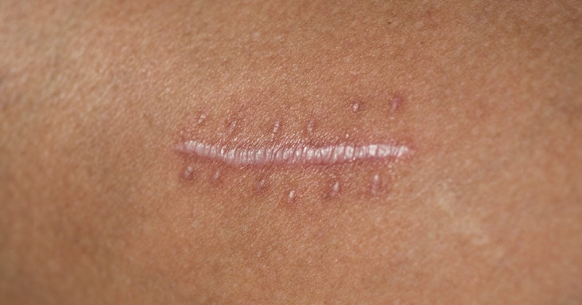 Como Cuidar Bem Da Cicatriz Após Uma Cirurgia Plástica Minha Vida