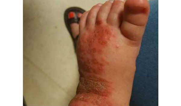 Bebê com os pés infectados por herpes