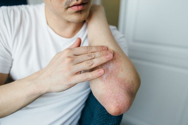 Homem com dermatite no braço