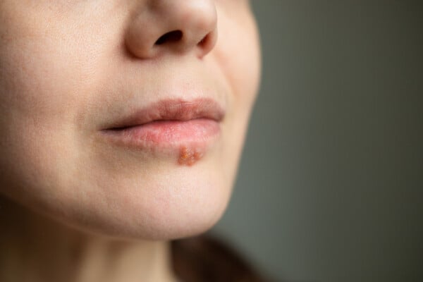 Foto aproximada de boca de mulher com feridas típicas da herpes labial