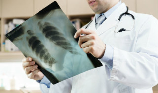 Radiografia de tórax - Foto: Getty Images