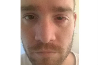 Conheça a história do homem que quase ficou cego de um olho por usar lente de contato por muito tempo - Foto: Reprodução DailyMail