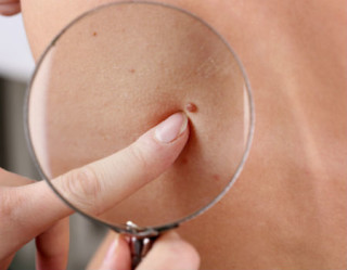 Aprenda como identificar um melanoma: 5 passos simples