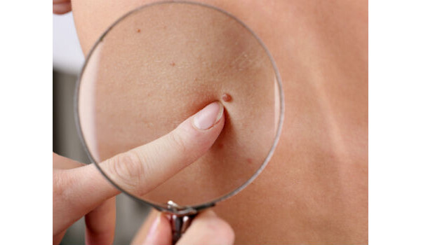 Aprenda como identificar um melanoma: 5 passos simples