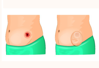 Ilustração mostra estoma (abertura feita na parede abdominal) na imagem à esquerda; e na imagem à direita, colocação de bolsa de colostomia - Imagem: Shutterstock