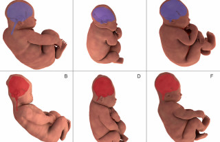 Novo estudo mostra como fica cabeça do bebê durante trabalho de parto